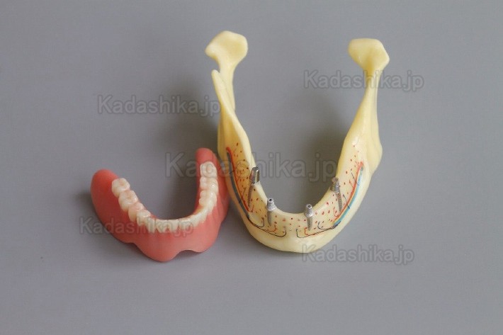 下顎骨組織とインプラント模型 + オーバーデンチャーモデル ＃2014 02