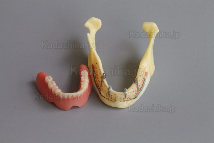 下顎骨組織とインプラント模型 + オーバーデンチャーモデル ＃2014 02