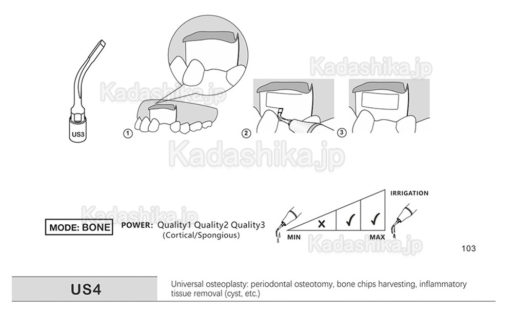 歯科ピエゾサージェリーチップ US1 US1L US1R US2 US3 US4 US5 US6 US7 US11 US12 (Mectron Woodpeckerに適用)