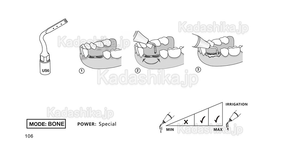 歯科ピエゾサージェリーチップ US1 US1L US1R US2 US3 US4 US5 US6 US7 US11 US12 (Mectron Woodpeckerに適用)