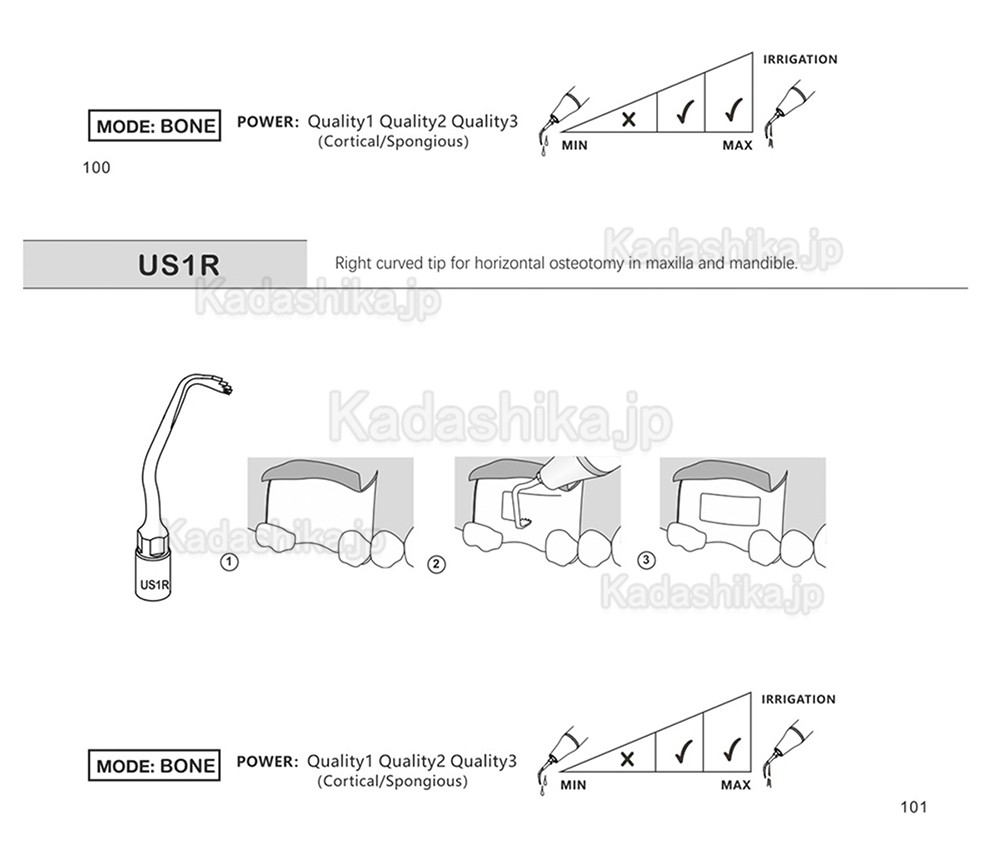 歯科ピエゾサージェリーチップ US1 US1L US1R US2 US3 US4 US5 US6 US7 US11 US12 (Mectron Woodpeckerに適用)